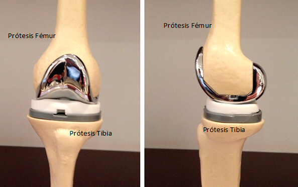 figura3 Reemplazo total de rodilla