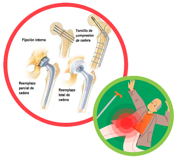 caidas Ortopedia y traumatología